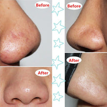 face-mask-suction-black-head-peel-masks-deep-cleansing-tearing-blackhead-remover-purifying BBL