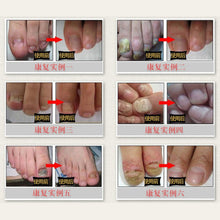 new-fungal-nail-treatment-essence-nail-and-foot-whitening-toe-nail-fungus-removal-feet-care-nail BBL
