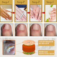 new-fungal-nail-treatment-essence-nail-and-foot-whitening-toe-nail-fungus-removal-feet-care-nail BBL